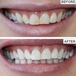 J2OYTEETH